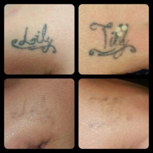 Tattoo removal in Nairobi, Kenya