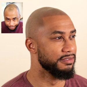 Scalp Micropigmentation in Nairobi, Kenya