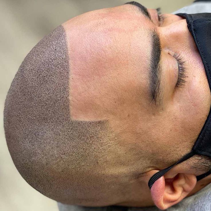 Scalp Micropigmentation Scalp Micropigmentation in Nairobi, Kenya