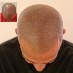 Scalp Micropigmentation in Nairobi