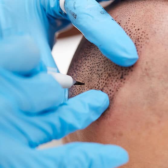 Scalp Micropigmentation _ New SMP® 2022 _ Hair Tattoo Toronto (1) Scalp Micropigmentation in Kenya