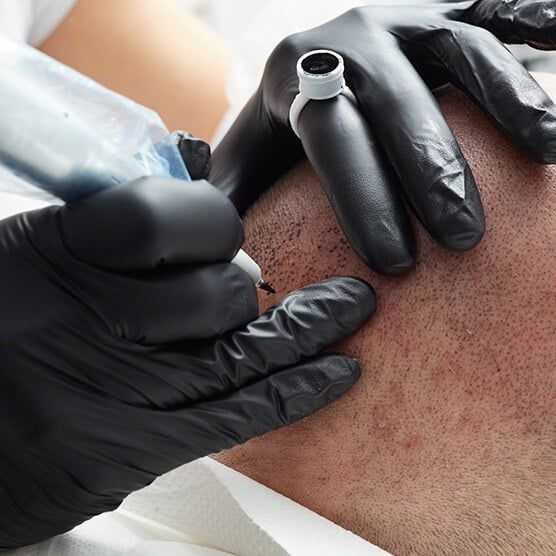 Scalp Micropigmentation Scalp Micropigmentation in Nairobi, Kenya