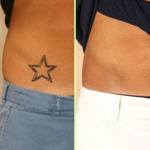 Tattoo removal before and after in Kenya