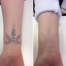 Tattoo removal in Nairobi, Kenya