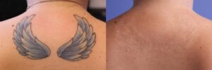 Tattoo Removal in Nairobi, Kenya