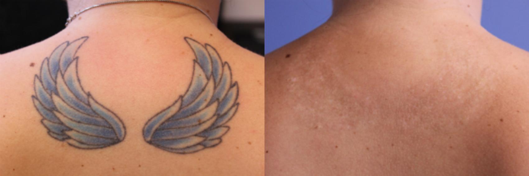 Tattoo Removal in Nairobi, Kenya