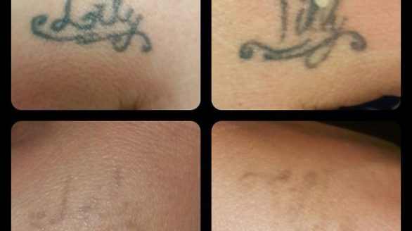 Tattoo removal progress Tattoo removal in Nairobi, Kenya