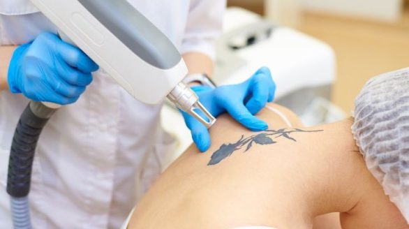 Tattoo Removal Process Laser Tattoo Removal in Nairobi, Kenya