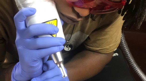 Laser Removal Laser Tattoo removal in Nairobi, Kenya