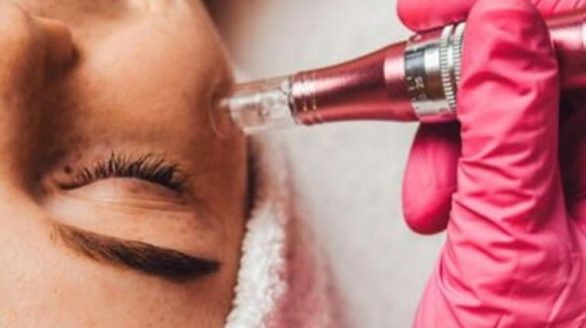 Micro-needling procedure in Nairobi Micro-needling in Nairobi