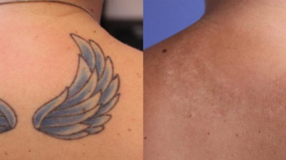 Picosecond Tattoo removal in Kenya Tattoo Removal in Nairobi, Kenya